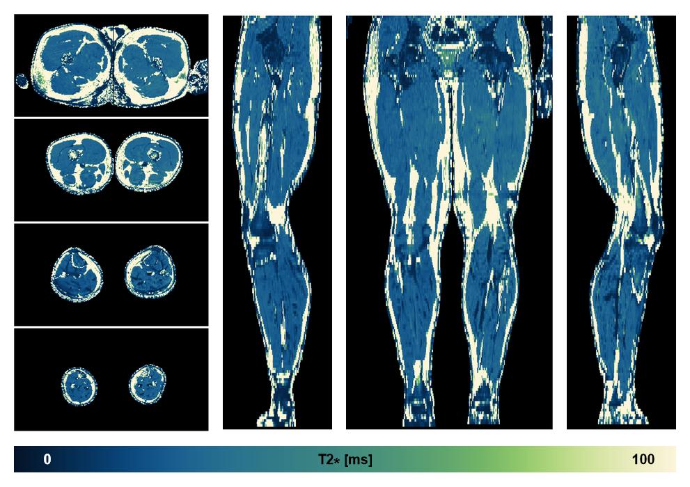 The T2 star relaxation time of the lower extremity obtained from the dixon reconstruction for muscle water fat quantification.
